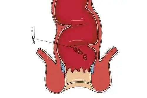肛门长息肉有哪些症状?