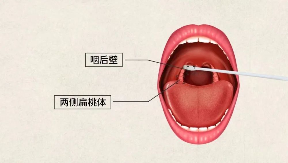触碰到整个口腔最里面的位置,这个地方被称为咽后壁,在咽后壁上擦拭