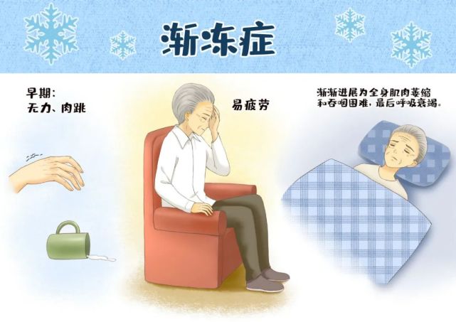 渐冻症的发病过程是怎样的如何及早发现初期端倪