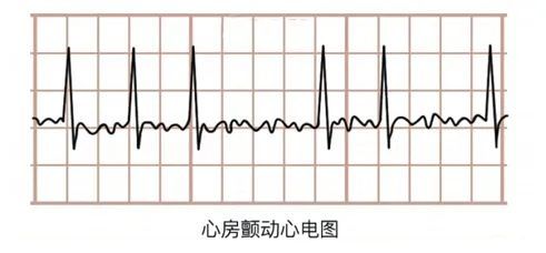 室颤的心电图分不清p波,qrs波群,st段和t波,整个心电图都成了波浪线
