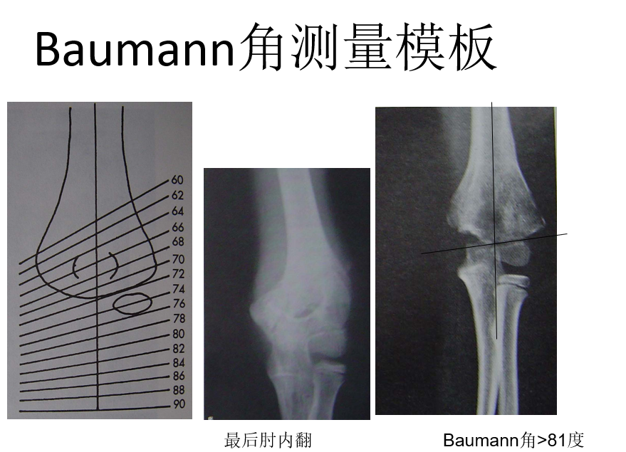 正常72度[64~81,81度以内,不会发生肘关节内翻∠b,现在baumann角∠a