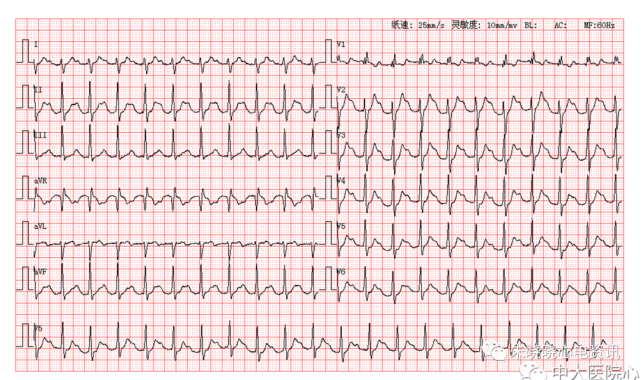 每日读图|第1743期 交界性早搏 交界性早搏
