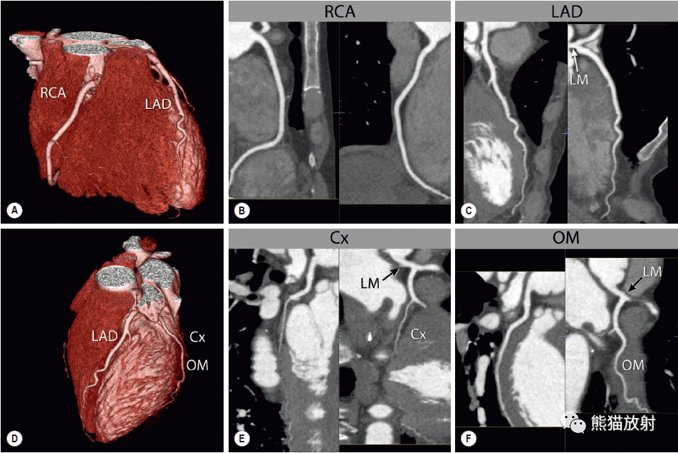 冠状动脉ct相关概念解剖