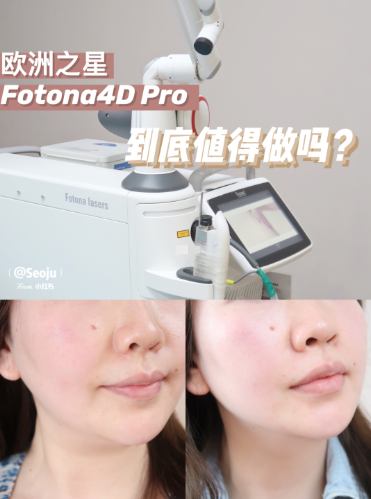 歐洲之星fotona4dpro和熱瑪吉哪個好做歐洲之星fotona4dpro多少錢