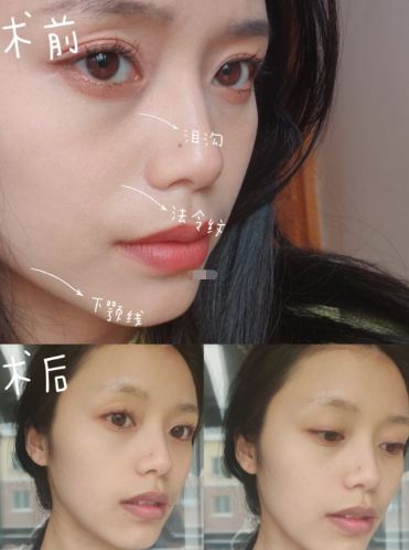 欧洲之星fotona4d面部提升效果真的有那么好吗?