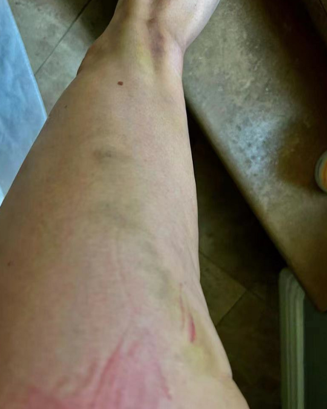 但也因为多次摔倒在水池子中的关系,最后杨紫琼的膝盖也受了一点轻伤