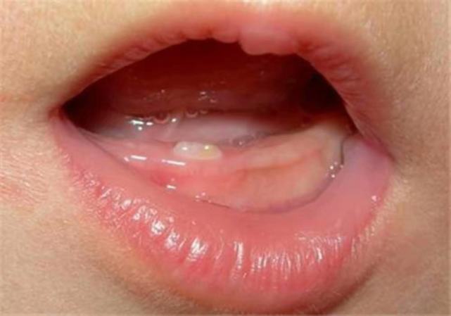 宝宝的乳牙一般要在4到10个月之间萌出,宝宝出牙的