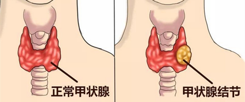 甲状腺腺瘤都有哪些特征?哪些情况需要马上治疗?