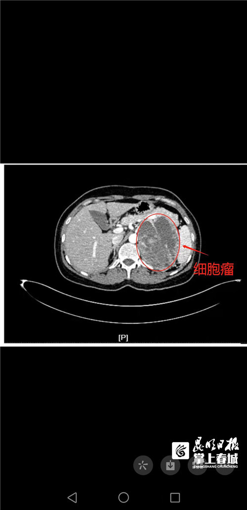 厉兵秣马术前准备15天 医生1小时摘除巨大肾上腺嗜铬细胞瘤