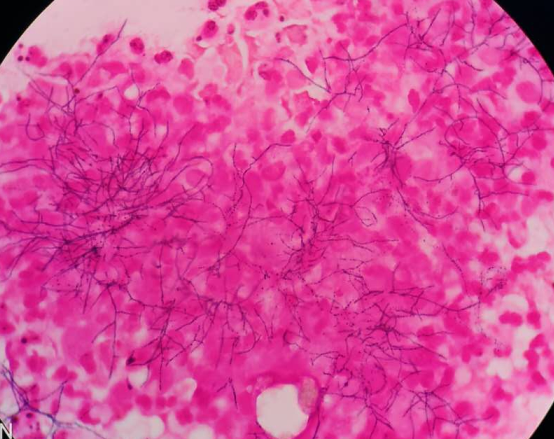 菌体为丝状,菌体丝有分枝,见图5;患者痰涂片弱抗酸染色:可见大量红色