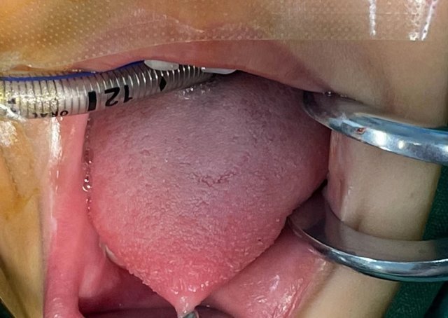 注意小朋友的舌筋到底要不要剪开屏新闻帮你问了专家