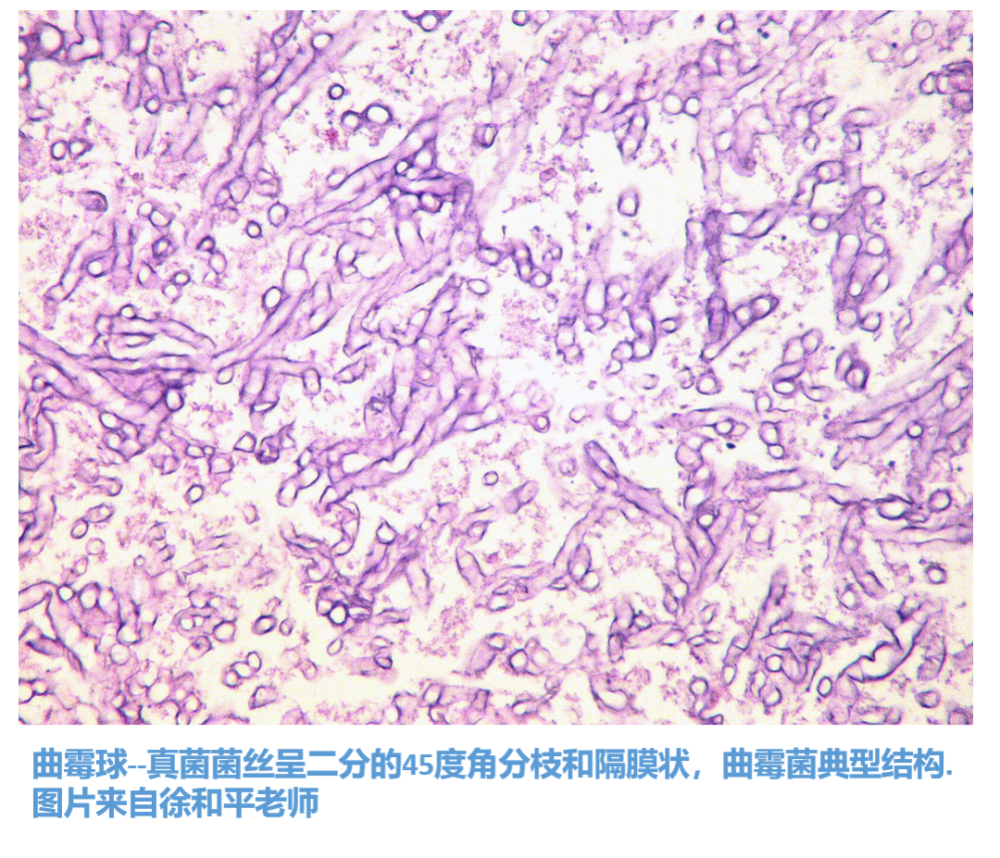 组织病理学何时可能是“侵袭性真菌病”唯一的重要诊断手段？检测霉菌感染时又有哪些优点和局限？_腾讯新闻