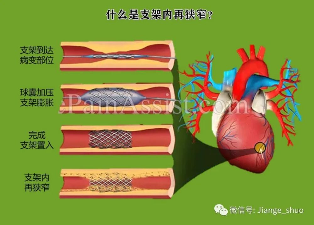 健哥說心臟有聲版狹窄血管放了支架為什麼還會再狹窄