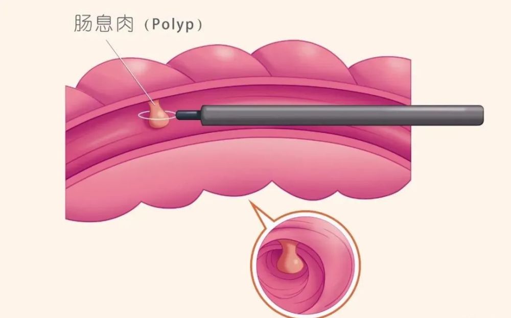 甘肅東大肛腸醫院為什麼會長胃腸息肉答案在這裡