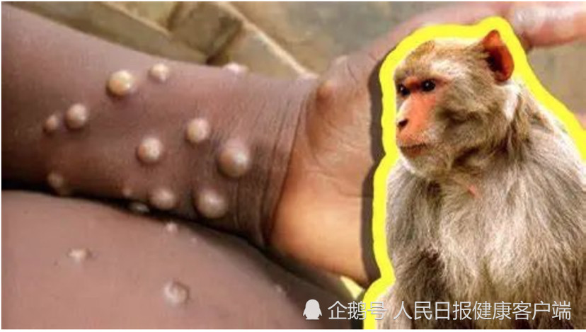 11国80例猴痘患者，我国尚未出现，专家：加强人物检疫冬季养生吃什么水果