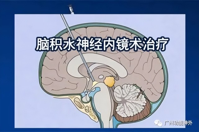 腦積水?這是腦袋裡的