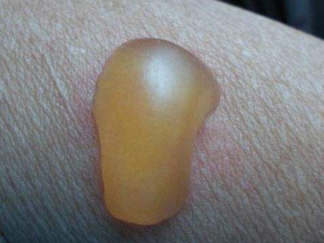 艾灸出现 "灸花"和 "水泡",可以这样处理!_腾讯新闻