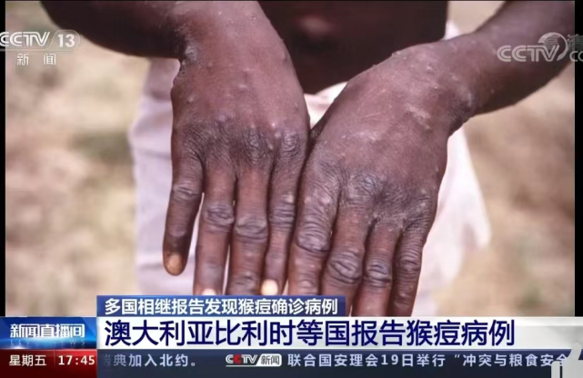 猴痘病毒来袭去年底美实验室惊现人痘天花瓶这世界有点乱了