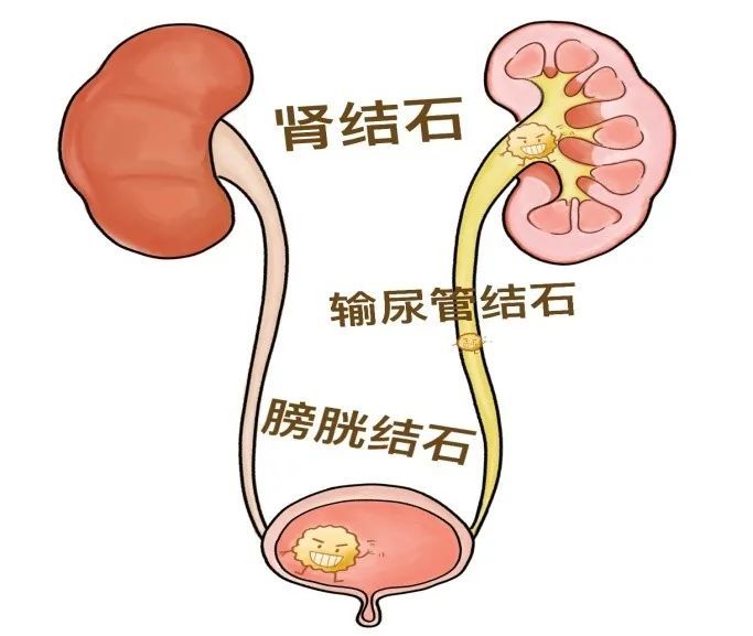 泌尿系统结石知多少