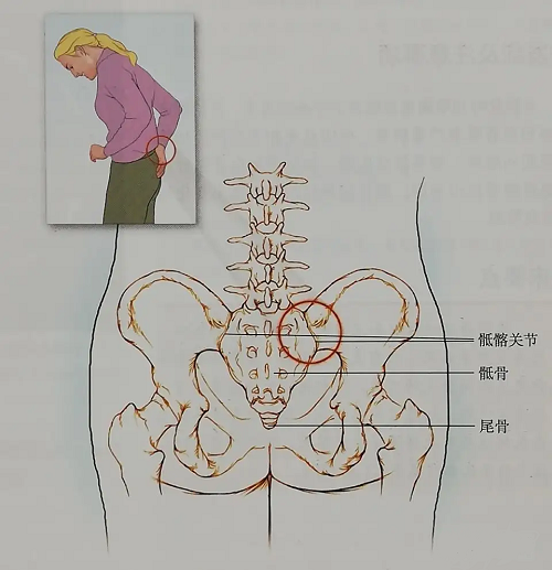 直樂大講堂:同樣是腰痛,腰椎間盤突出與骶髂痛的區別是什麼