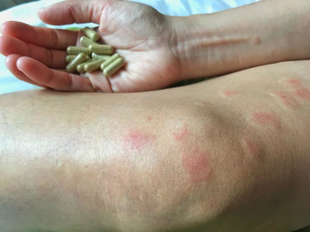 系统性红斑狼疮治疗的原则和注意事项_腾讯新闻