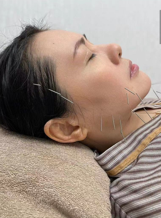 当天李丽珍躺在床上做针灸,据她自己说,这次针灸是为了瘦脸,迎接7月份