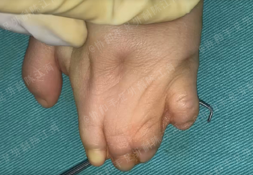 孩子出生即是灾难手指并在一起粘连该不该放弃治疗