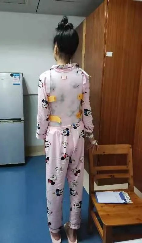 专家提醒:青少年需警惕脊柱侧弯