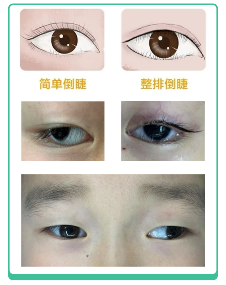 娃揉眼眨眼频繁比结膜炎更难缠的是倒睫千万别自己剪