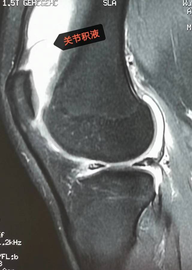 膝关节积液核磁图图片