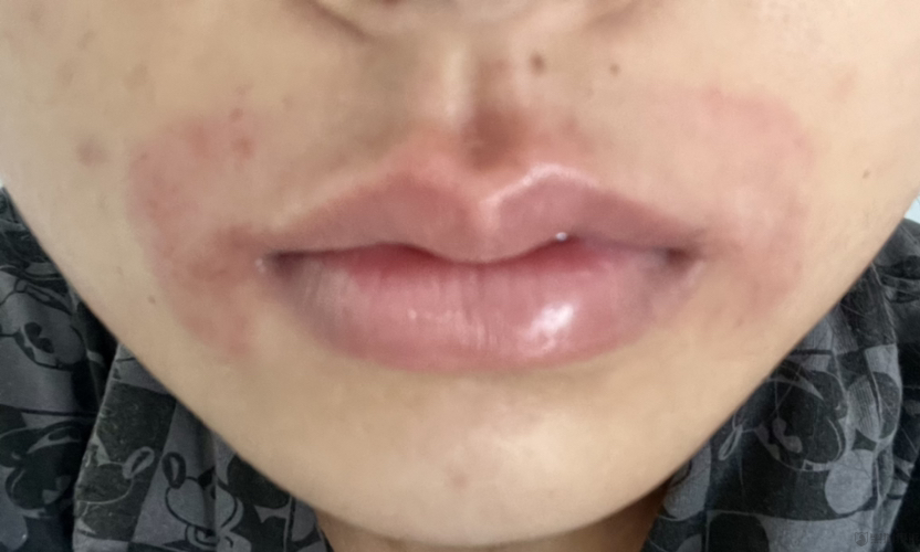 消费者投诉:宫芙脱毛膏使用后出现红肿刺痛_腾讯新闻