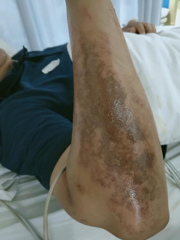 50岁男子甩鱼竿触到高压线被电击伤,右手右臂烧伤晕倒在地_腾讯新闻