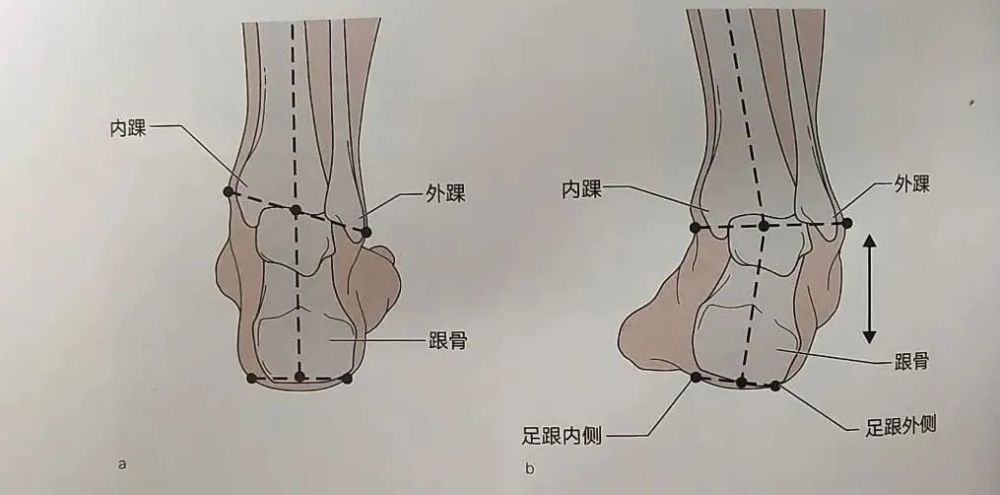 a 正常足,b 足內翻6足外翻自查:識別足外翻很容易,家長可以看下寶寶的