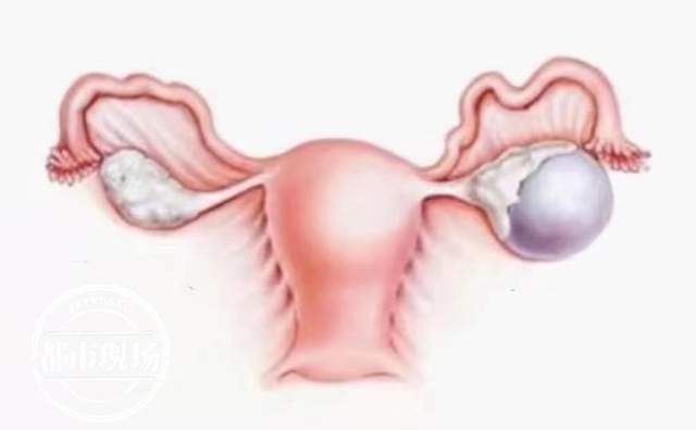 南昌一8岁女童卵巢里长出大鸡蛋最终从肚脐取出