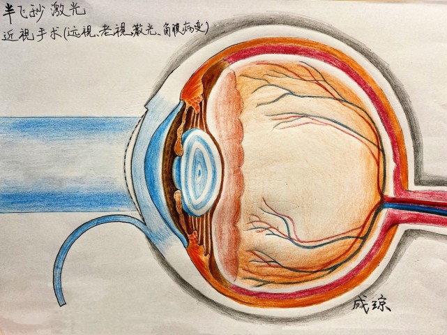 为做好精细手术苦练左手作画,眼科医生手绘眼病图谱实力圈粉