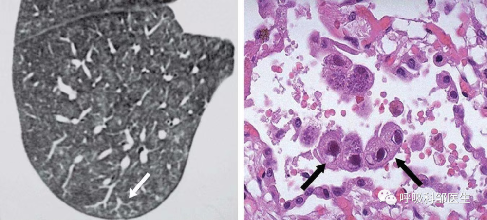 侵襲性肺真菌病(invasion pulmonarymyco sis)通常是指真菌直接侵入肺