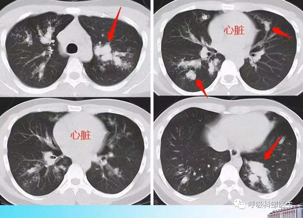 如何確診肺部真菌感染及治療