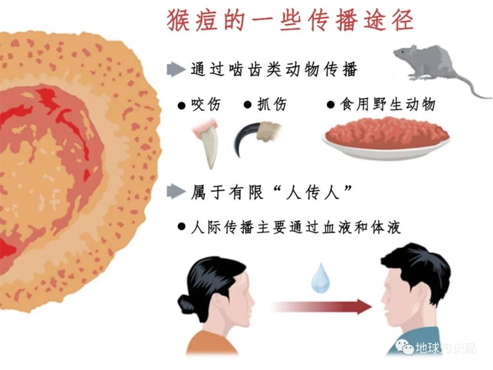 是时候了解“猴痘”了上海绘本树英语