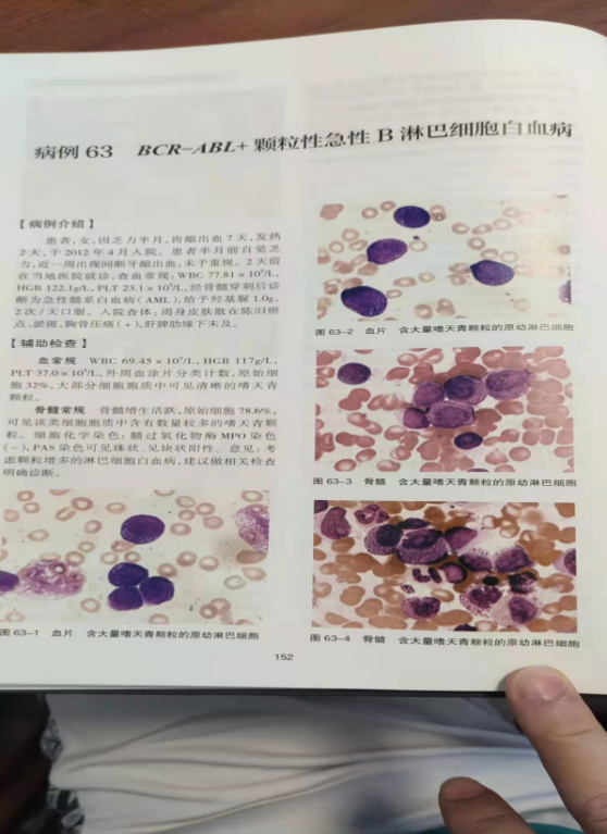 一例颗粒性急性t淋巴细胞白血病案例分享