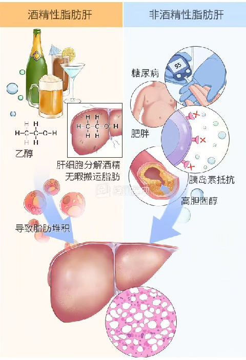 安信科普一文讀懂如何逆轉脂肪肝