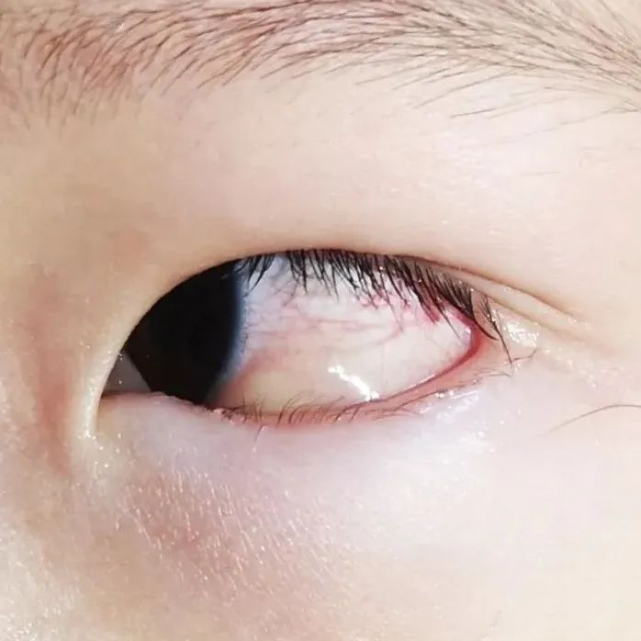 揉得眼泪直流,双眼红肿都停不下来最近总是不停揉眼睛7岁的平湖小朋友