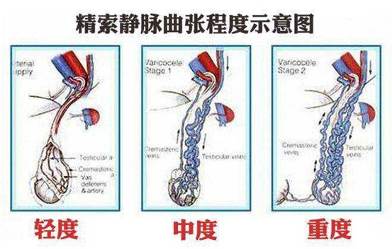 男性不育的冷麵殺手精索靜脈曲張