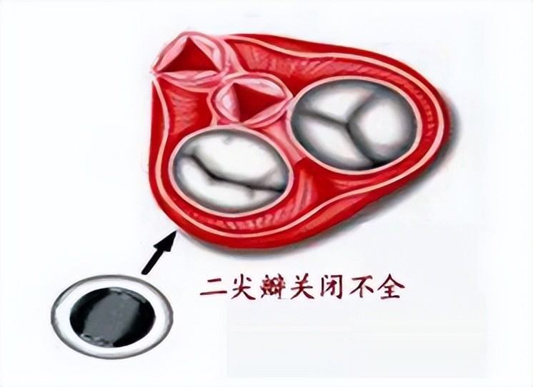 做完心臟彩超提示二尖瓣或三尖瓣狹窄二尖瓣返流嚴重嗎