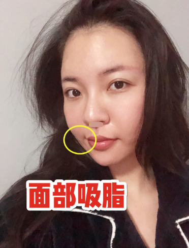 面部吸脂有什么危险跟副作用,面部吸脂术后注意哪些事项