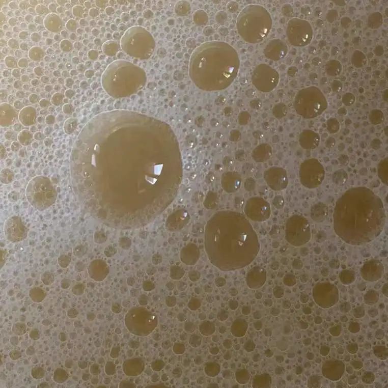 3,泡沫样白带白带量多,性状如豆渣呈絮状或凝乳状,常伴有阴道奇痒,如