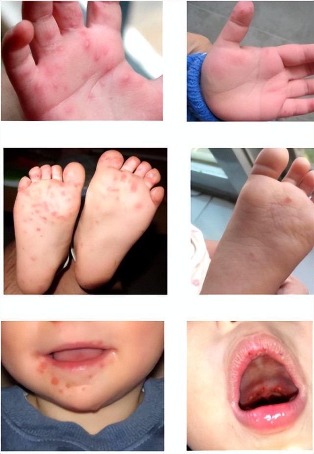 左边是较严重的情况 右边是较轻微的情况手足口病疱疹4.