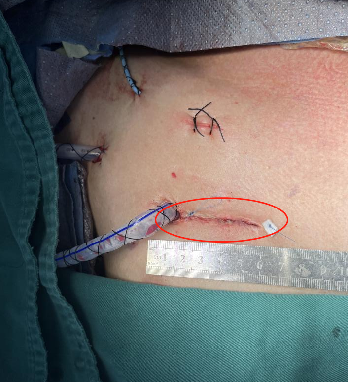 福建首例厦心成功开展高难度微创主动脉根部替换手术