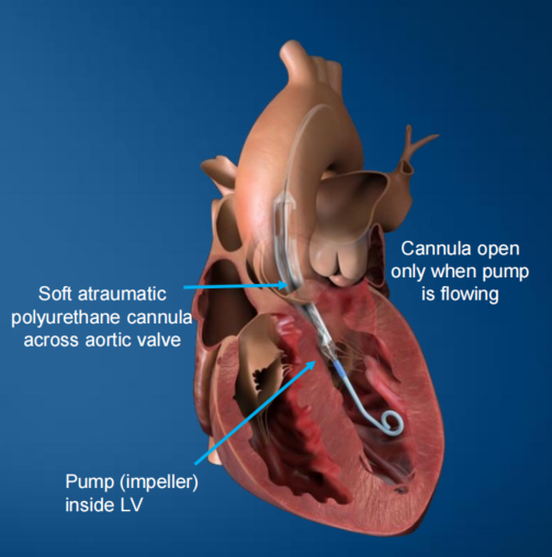 abiomed:全球最小心脏泵impella ecp不确定的商业化之路_腾讯新闻