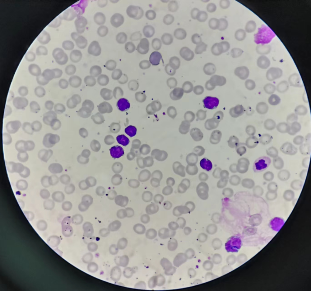 同样的白细胞危急值,同样的淋巴细胞比例升高,看似相同,实则不然_腾讯