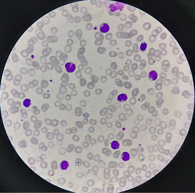 同样的白细胞危急值,同样的淋巴细胞比例升高,看似相同,实则不然_腾讯